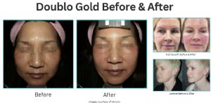 Doublo Gold B&A.png